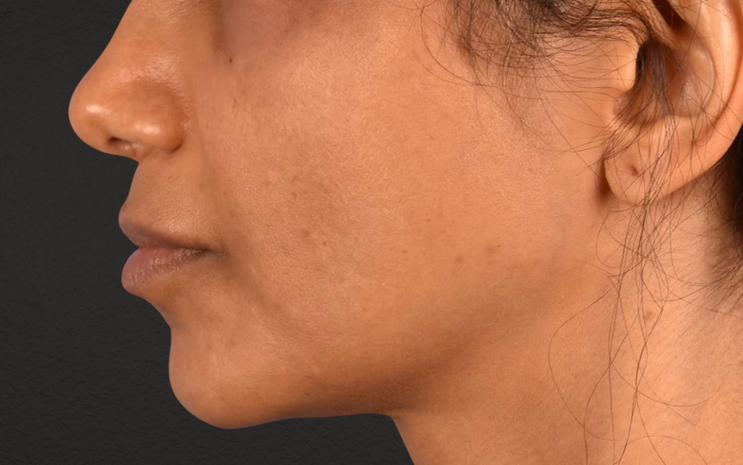 Lip Lift Before & After Gallery - Patient 369454 - Image 5