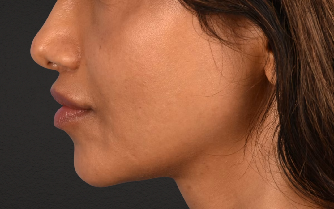 Lip Lift Before & After Gallery - Patient 369454 - Image 6