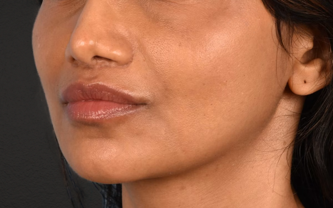 Lip Lift Before & After Gallery - Patient 369454 - Image 4