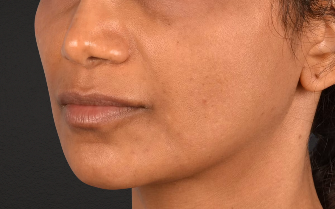 Lip Lift Before & After Gallery - Patient 369454 - Image 3