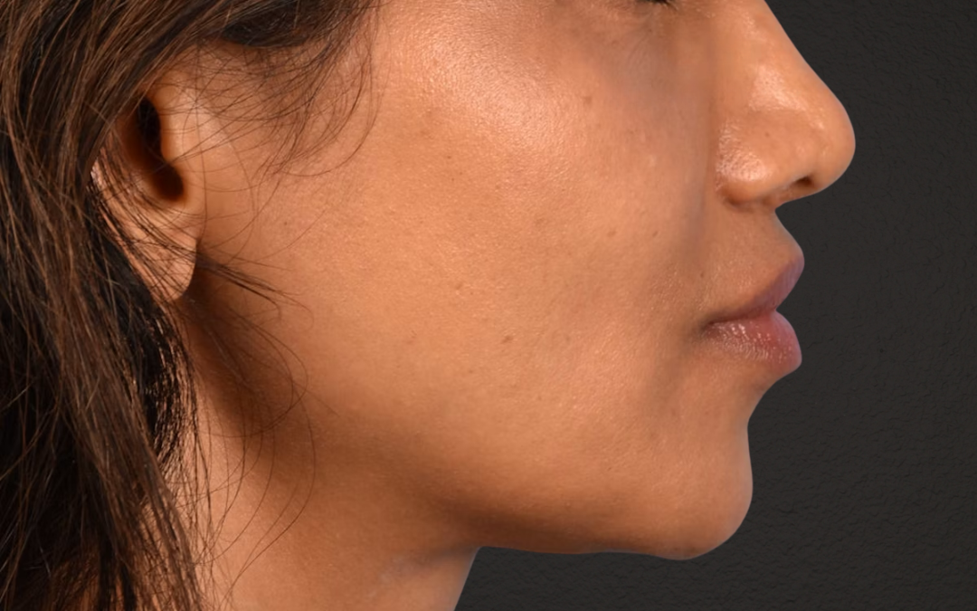 Lip Lift Before & After Gallery - Patient 369454 - Image 8