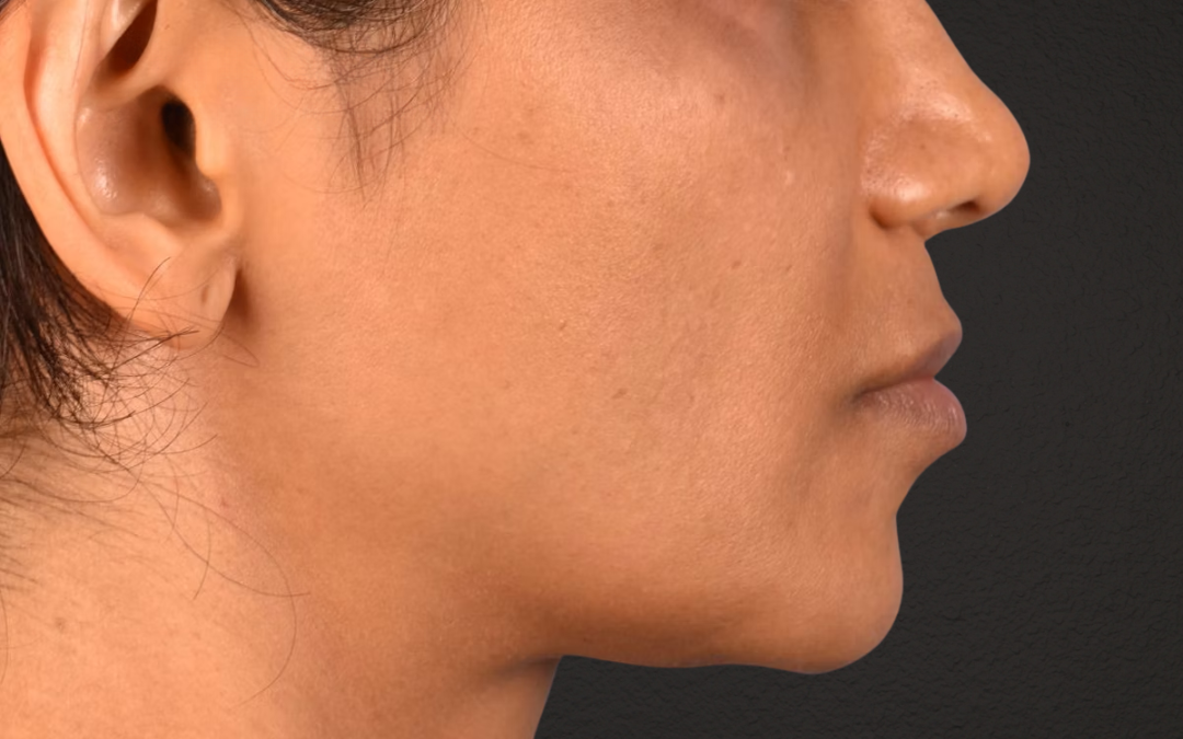 Lip Lift Before & After Gallery - Patient 369454 - Image 7
