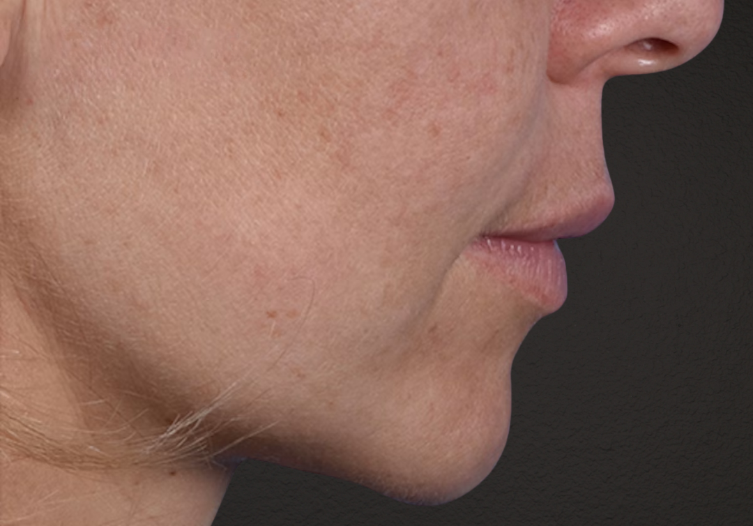 Lip Lift Before & After Gallery - Patient 797589 - Image 5