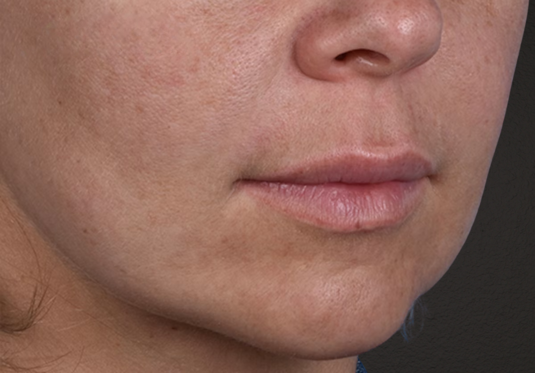 Lip Lift Before & After Gallery - Patient 797589 - Image 3