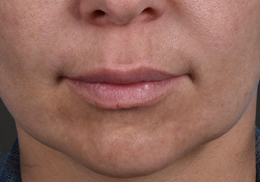 Lip Lift Before & After Gallery - Patient 797589 - Image 1