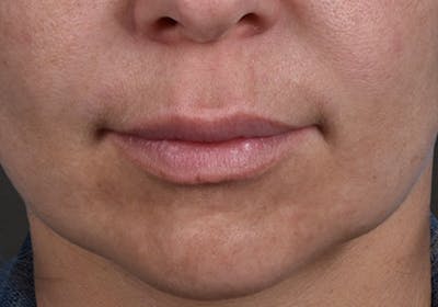 Lip Lift Before & After Gallery - Patient 797589 - Image 1