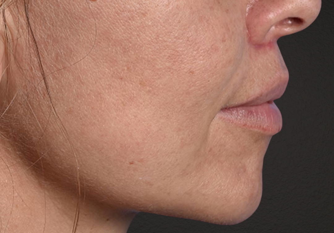 Lip Lift Before & After Gallery - Patient 797589 - Image 6