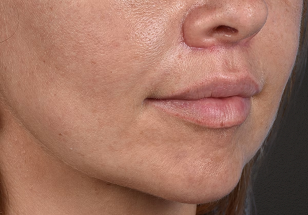 Lip Lift Before & After Gallery - Patient 797589 - Image 4
