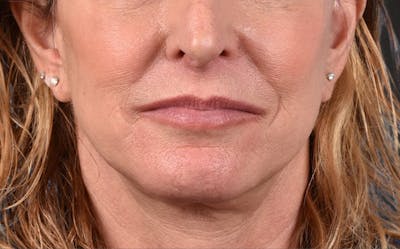 Lip Lift Before & After Gallery - Patient 135816 - Image 2