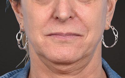 Lip Lift Before & After Gallery - Patient 135816 - Image 1