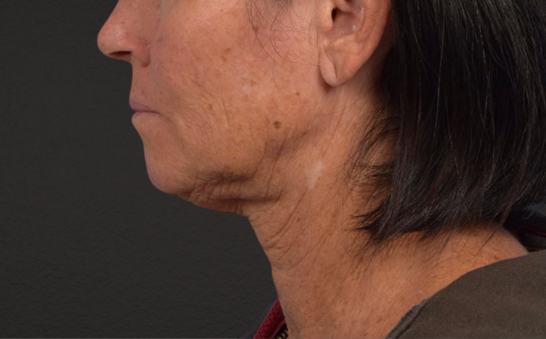 Lip Lift Before & After Gallery - Patient 587833 - Image 5