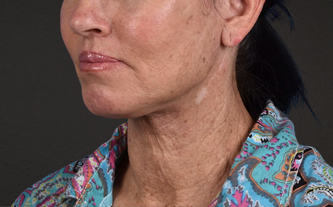 Lip Lift Before & After Gallery - Patient 587833 - Image 4
