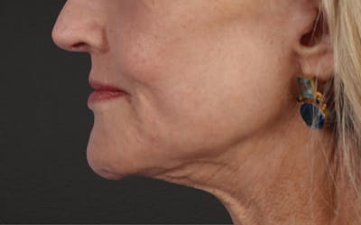 Lip Lift Before & After Gallery - Patient 340858 - Image 2