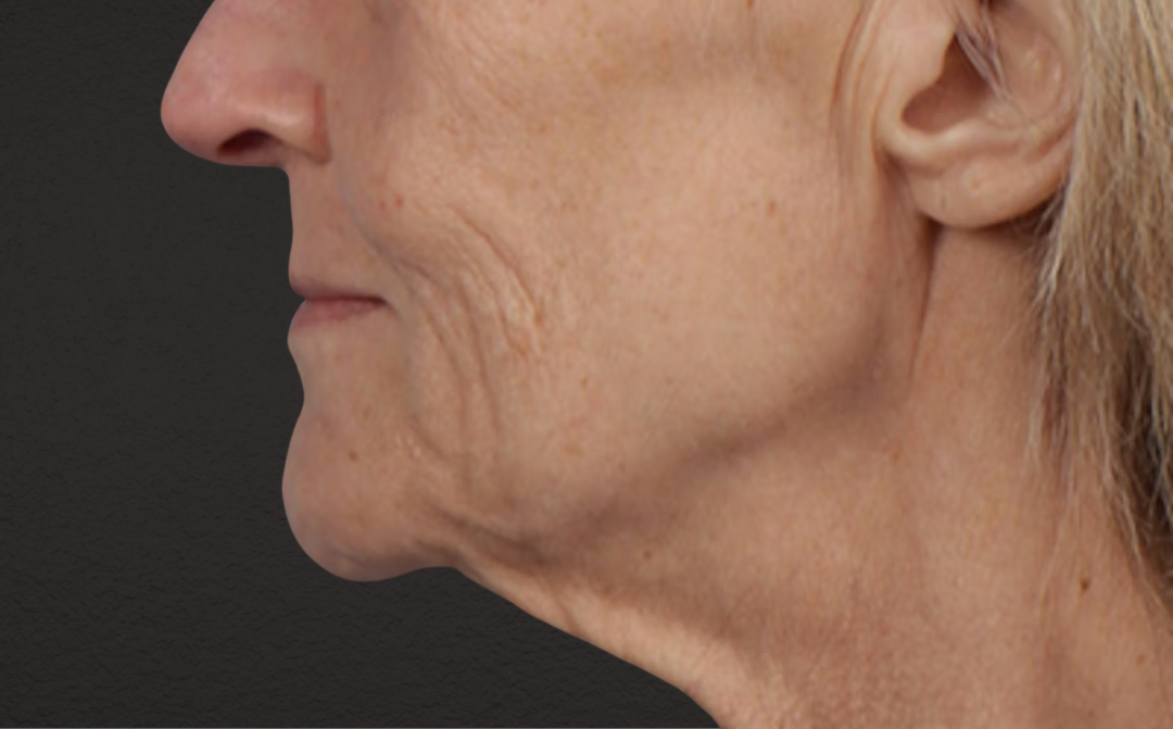Lip Lift Before & After Gallery - Patient 340858 - Image 1