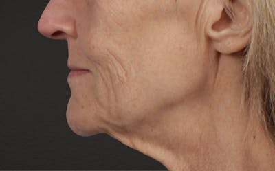 Lip Lift Before & After Gallery - Patient 340858 - Image 1
