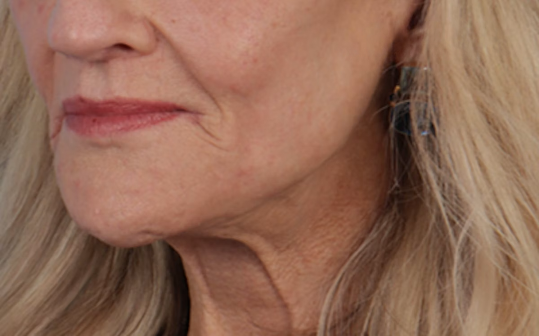 Lip Lift Before & After Gallery - Patient 340858 - Image 4