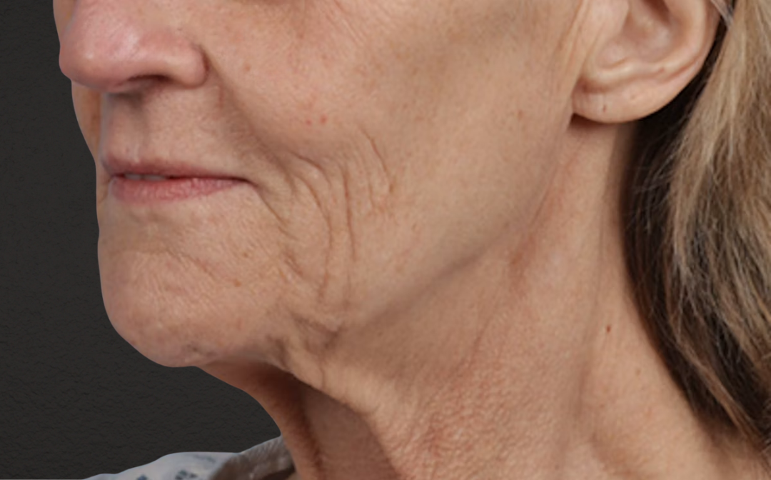 Lip Lift Before & After Gallery - Patient 340858 - Image 3
