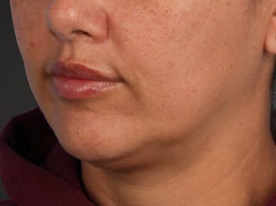 Lip Lift Before & After Gallery - Patient 191794 - Image 2