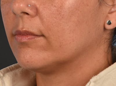 Lip Lift Before & After Gallery - Patient 191794 - Image 1