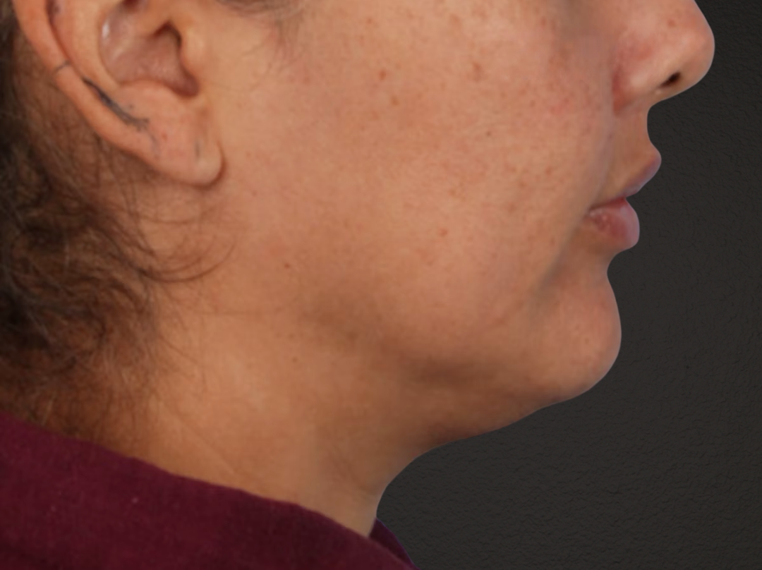 Lip Lift Before & After Gallery - Patient 191794 - Image 4