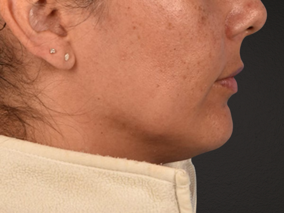 Lip Lift Before & After Gallery - Patient 191794 - Image 3