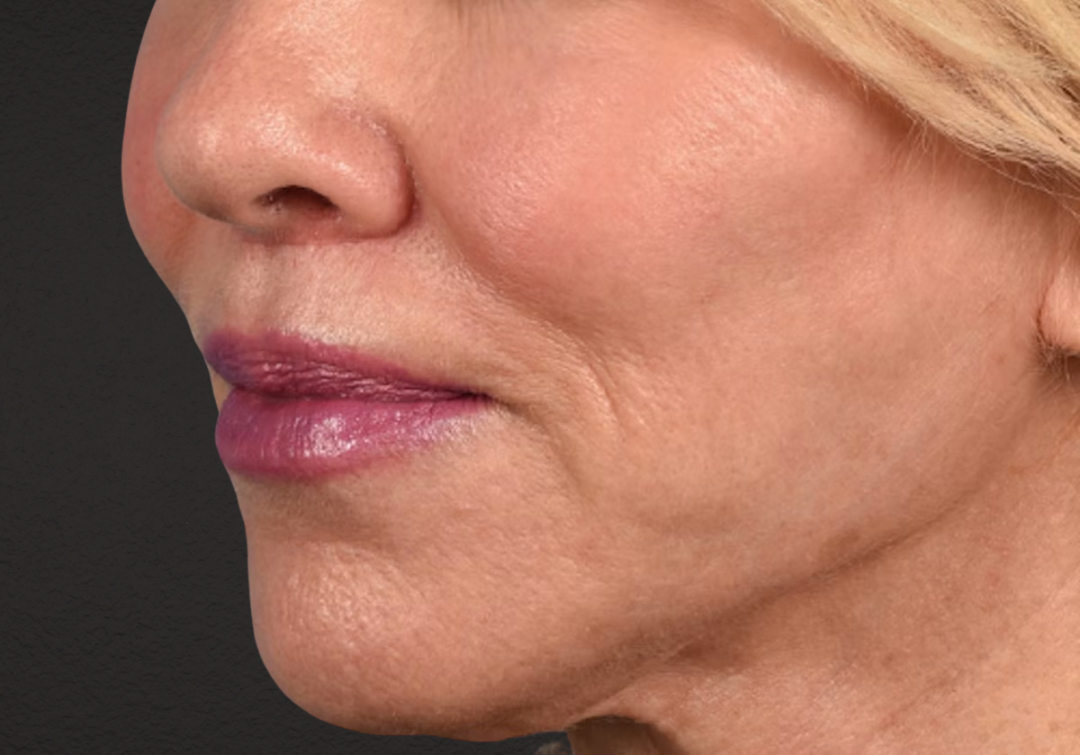 Lip Lift Before & After Gallery - Patient 698728 - Image 2