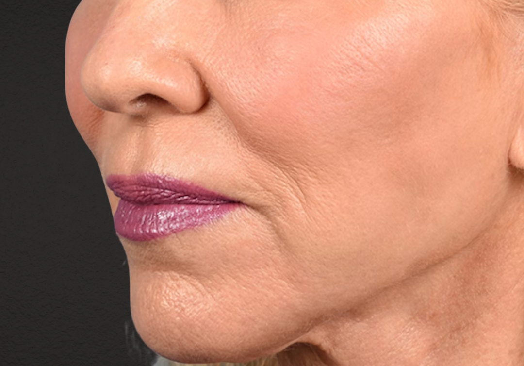 Lip Lift Before & After Gallery - Patient 698728 - Image 1