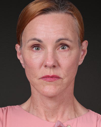 Co2 Laser Before & After Gallery - Patient 110268 - Image 2