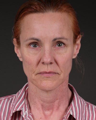Co2 Laser Before & After Gallery - Patient 110268 - Image 1