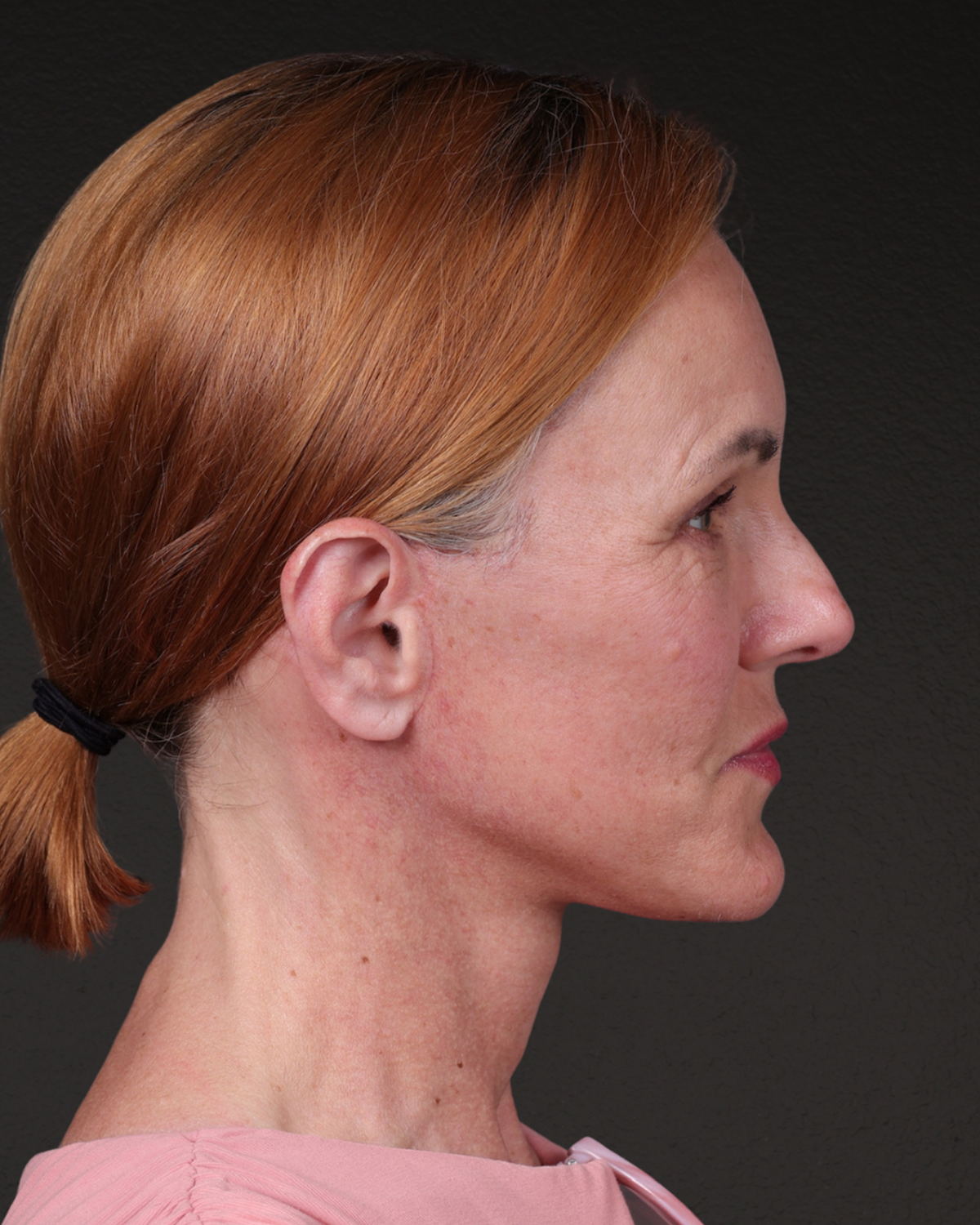 Fat Grafting Before & After Gallery - Patient 188665 - Image 6