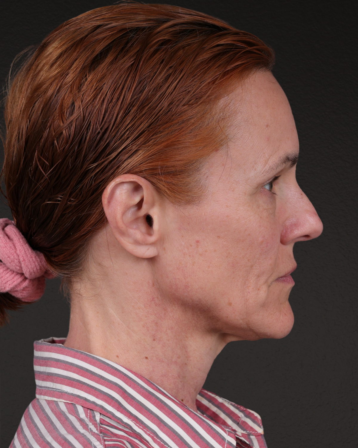 Fat Grafting Before & After Gallery - Patient 188665 - Image 5