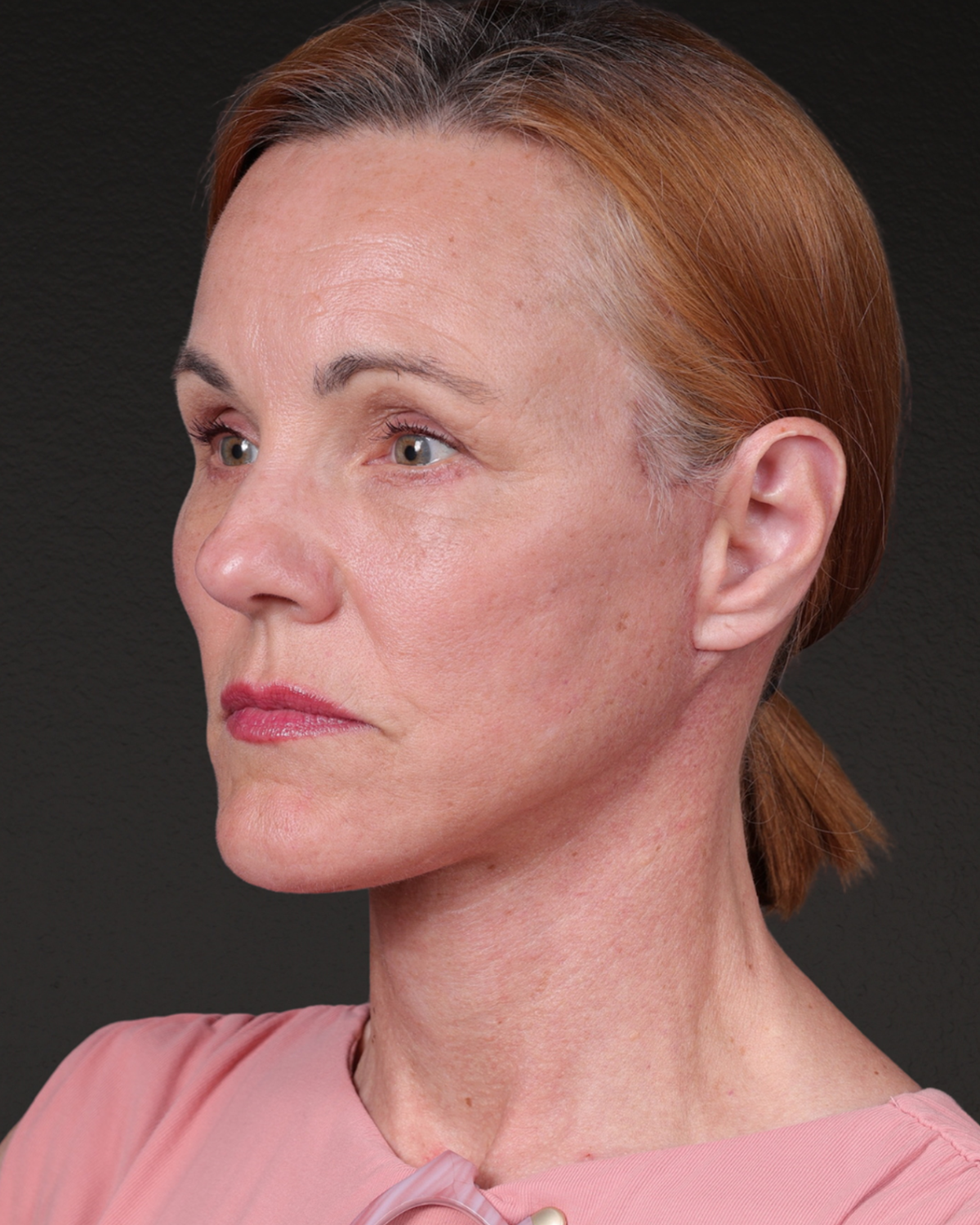 Fat Grafting Before & After Gallery - Patient 188665 - Image 8