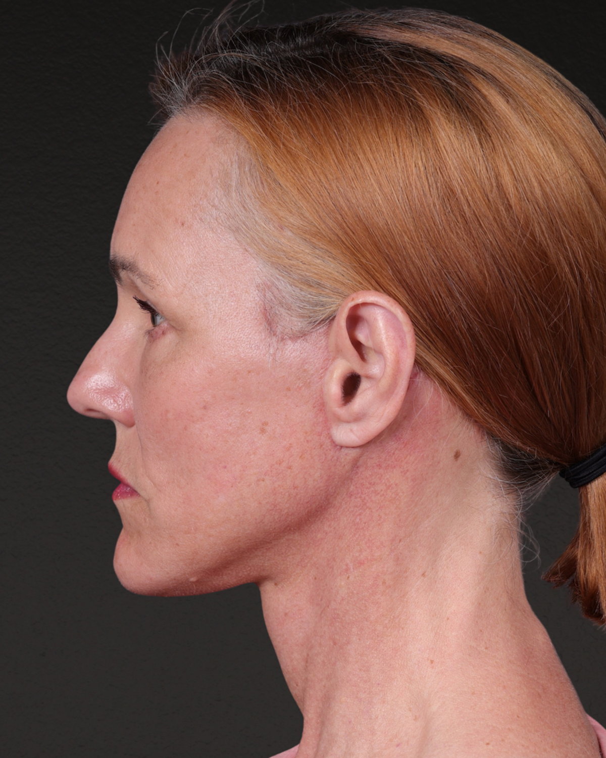 Fat Grafting Before & After Gallery - Patient 188665 - Image 10
