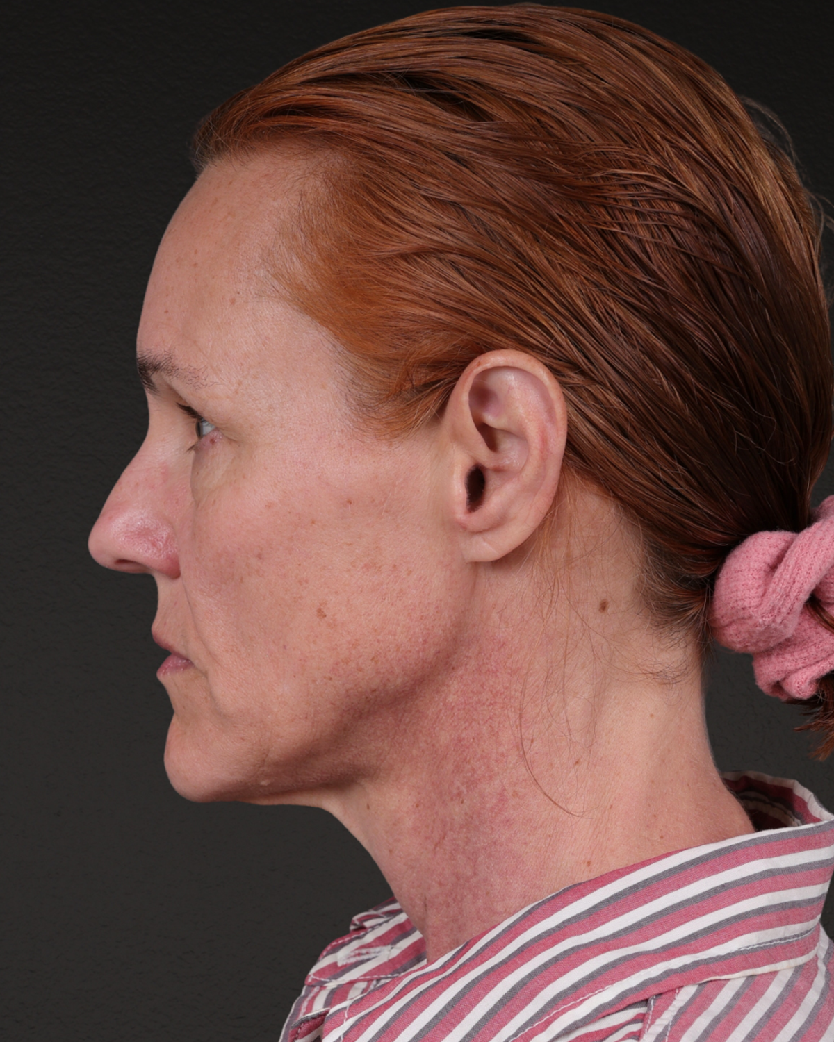 Fat Grafting Before & After Gallery - Patient 188665 - Image 9