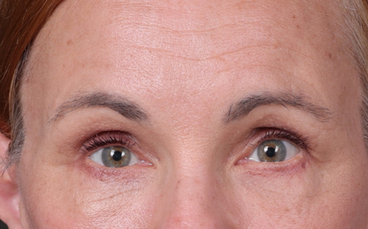 Brow Lift Before & After Gallery - Patient 363898 - Image 2