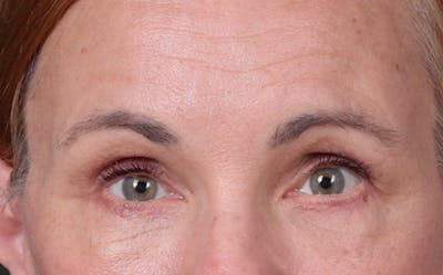 Blepharoplasty Before & After Gallery - Patient 117386 - Image 2