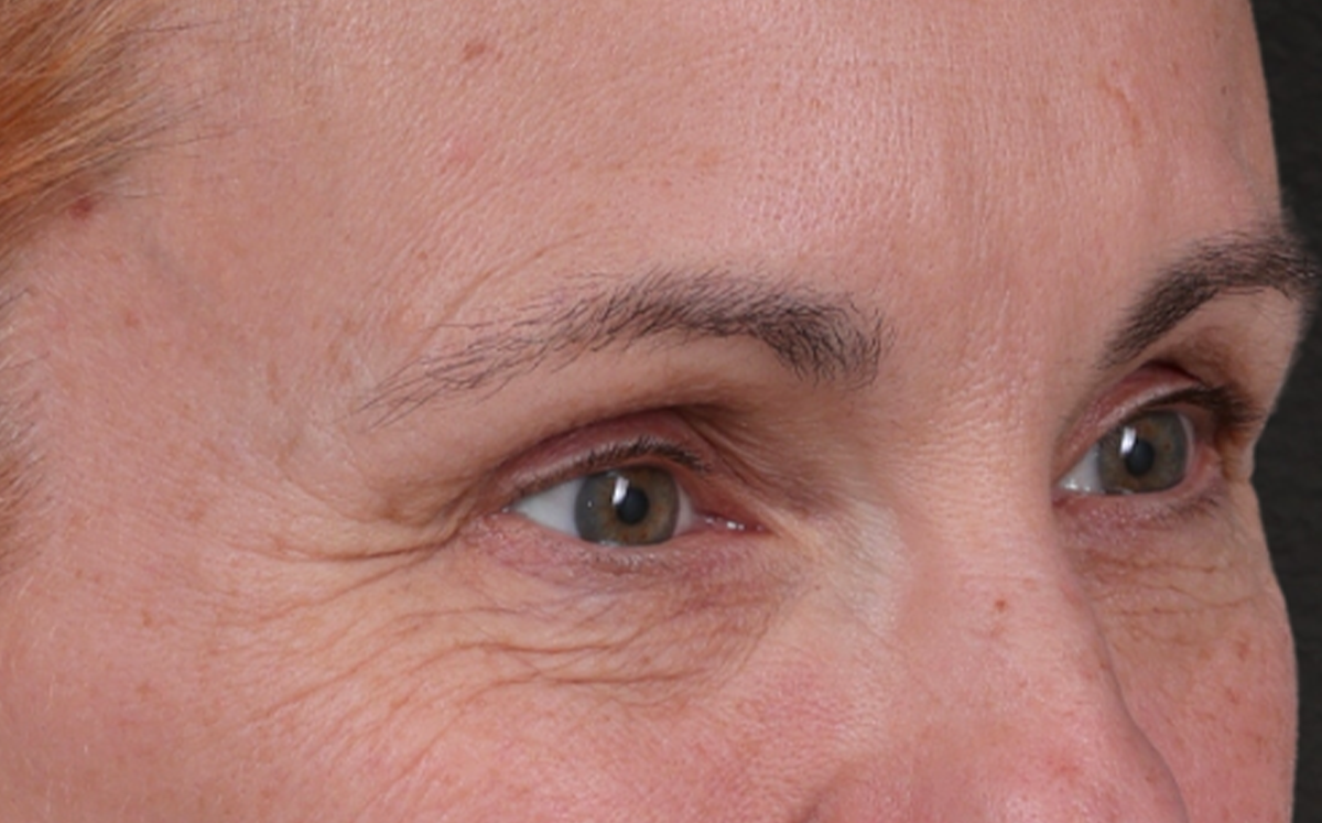 Brow Lift Before & After Gallery - Patient 363898 - Image 3