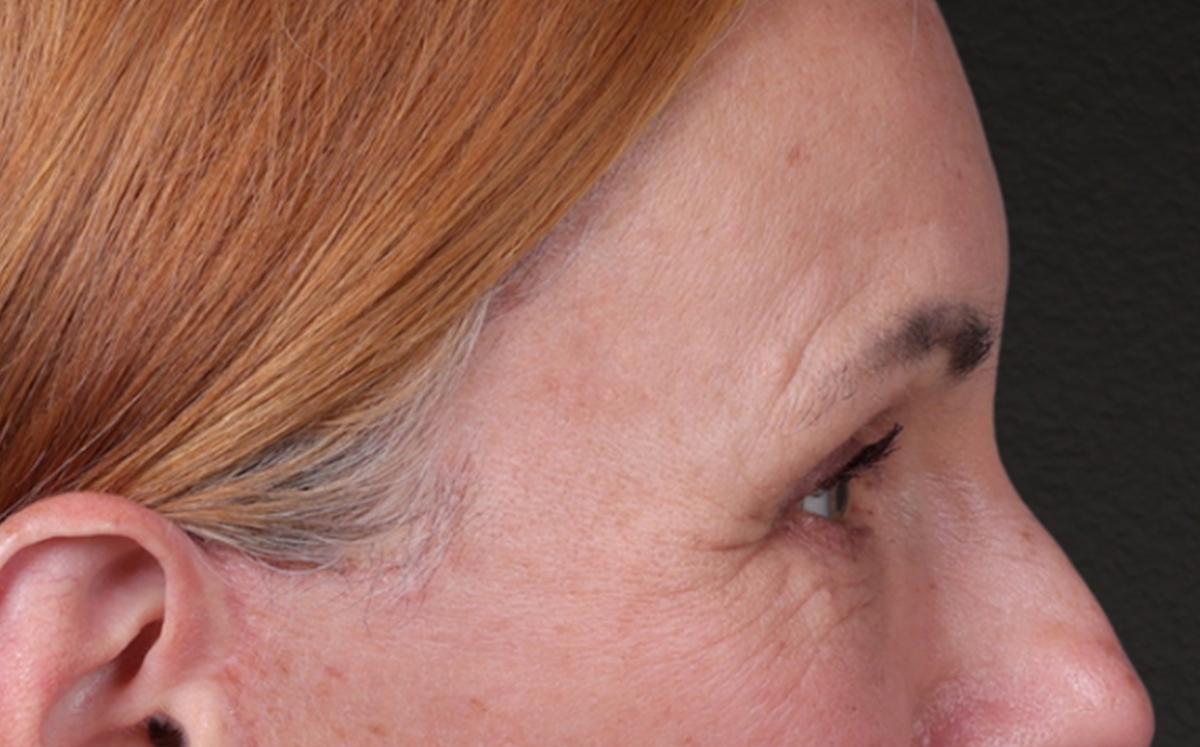 Brow Lift Before & After Gallery - Patient 363898 - Image 6