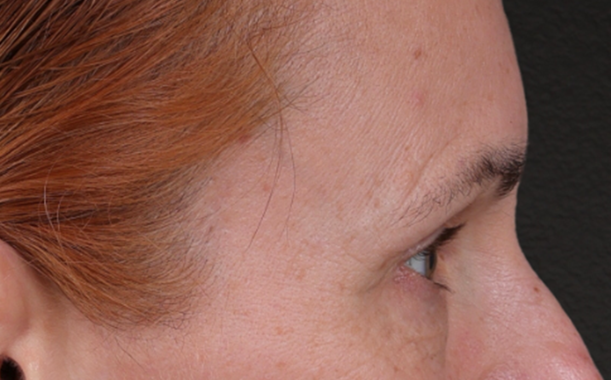 Brow Lift Before & After Gallery - Patient 363898 - Image 5