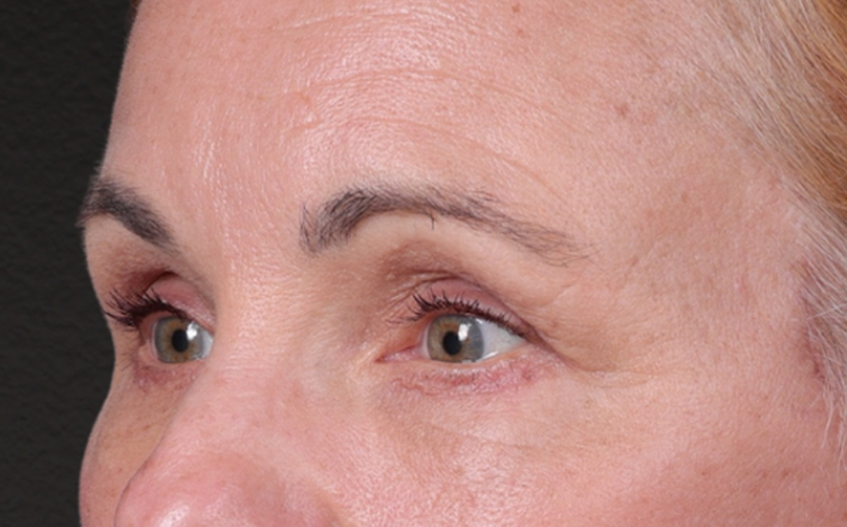 Brow Lift Before & After Gallery - Patient 363898 - Image 8