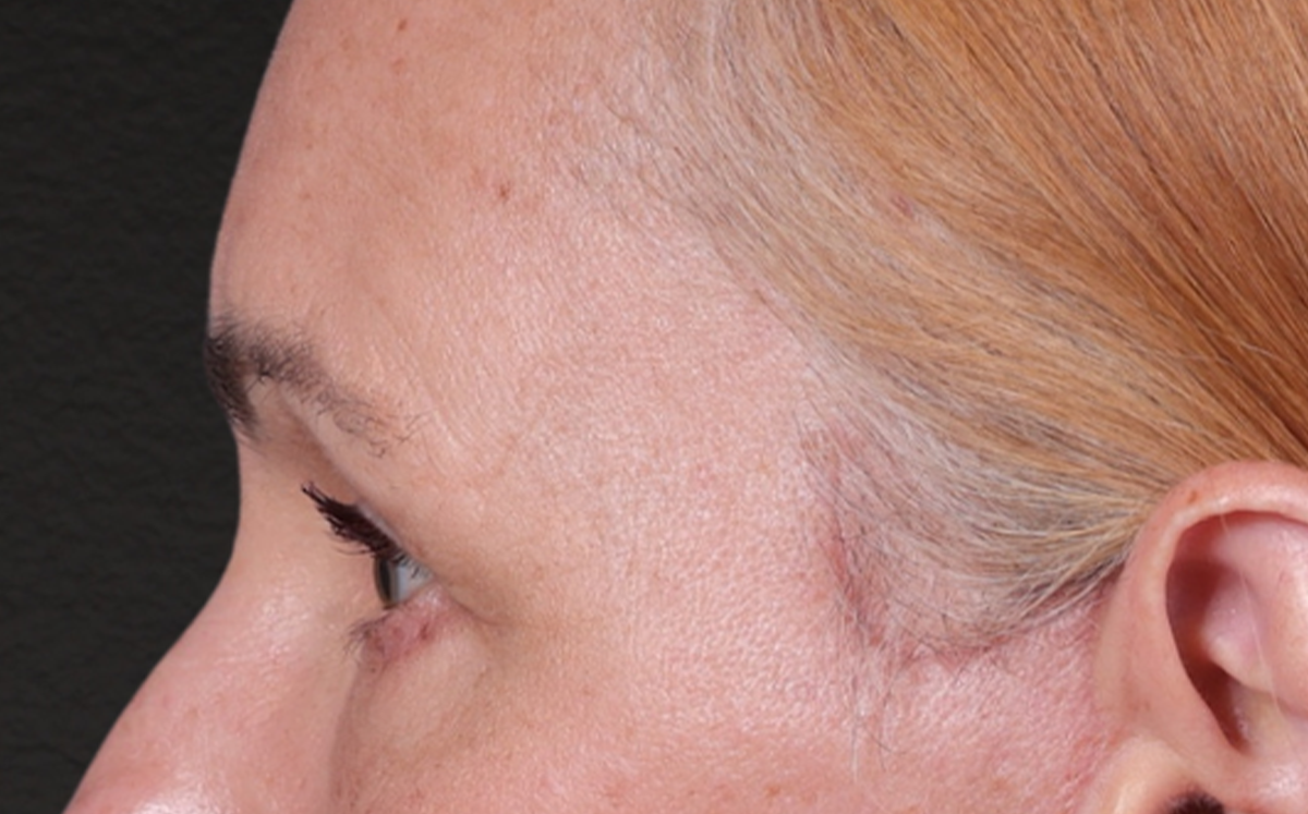 Brow Lift Before & After Gallery - Patient 363898 - Image 10