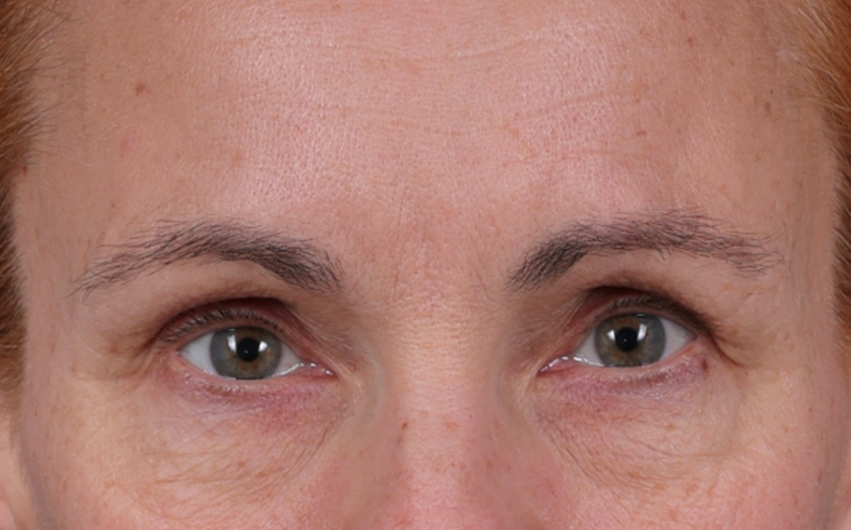 Brow Lift Before & After Gallery - Patient 363898 - Image 1