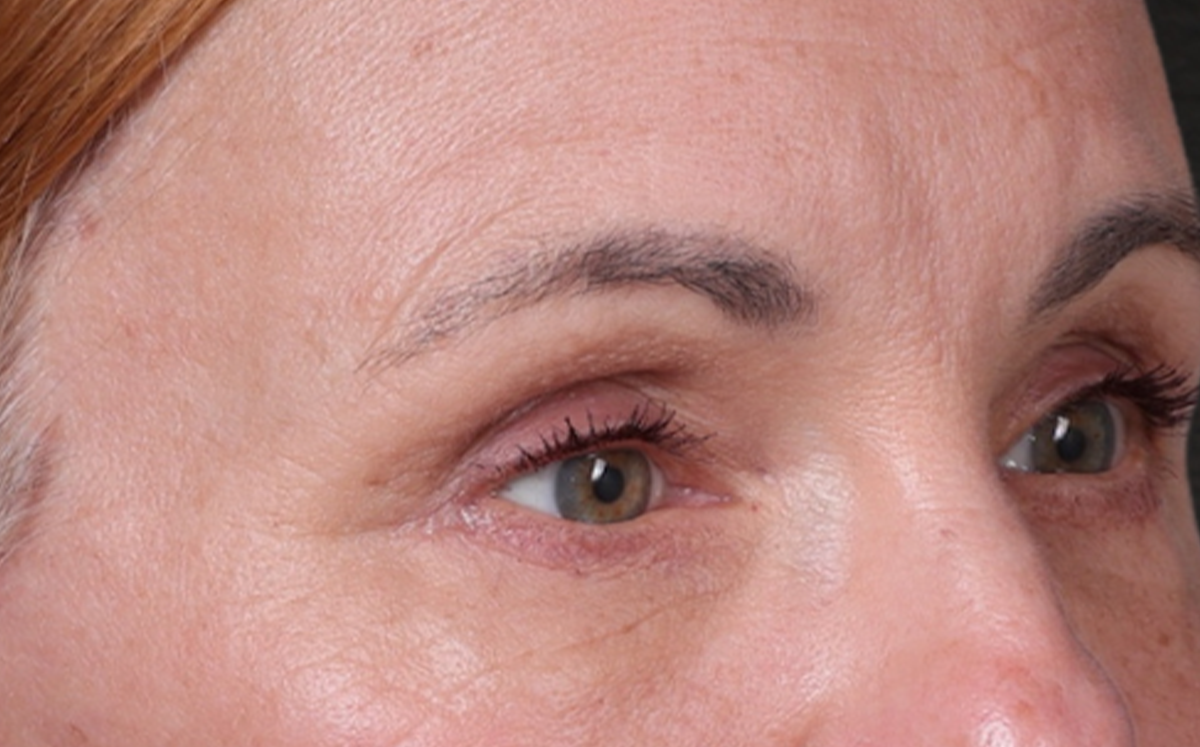 Brow Lift Before & After Gallery - Patient 363898 - Image 4