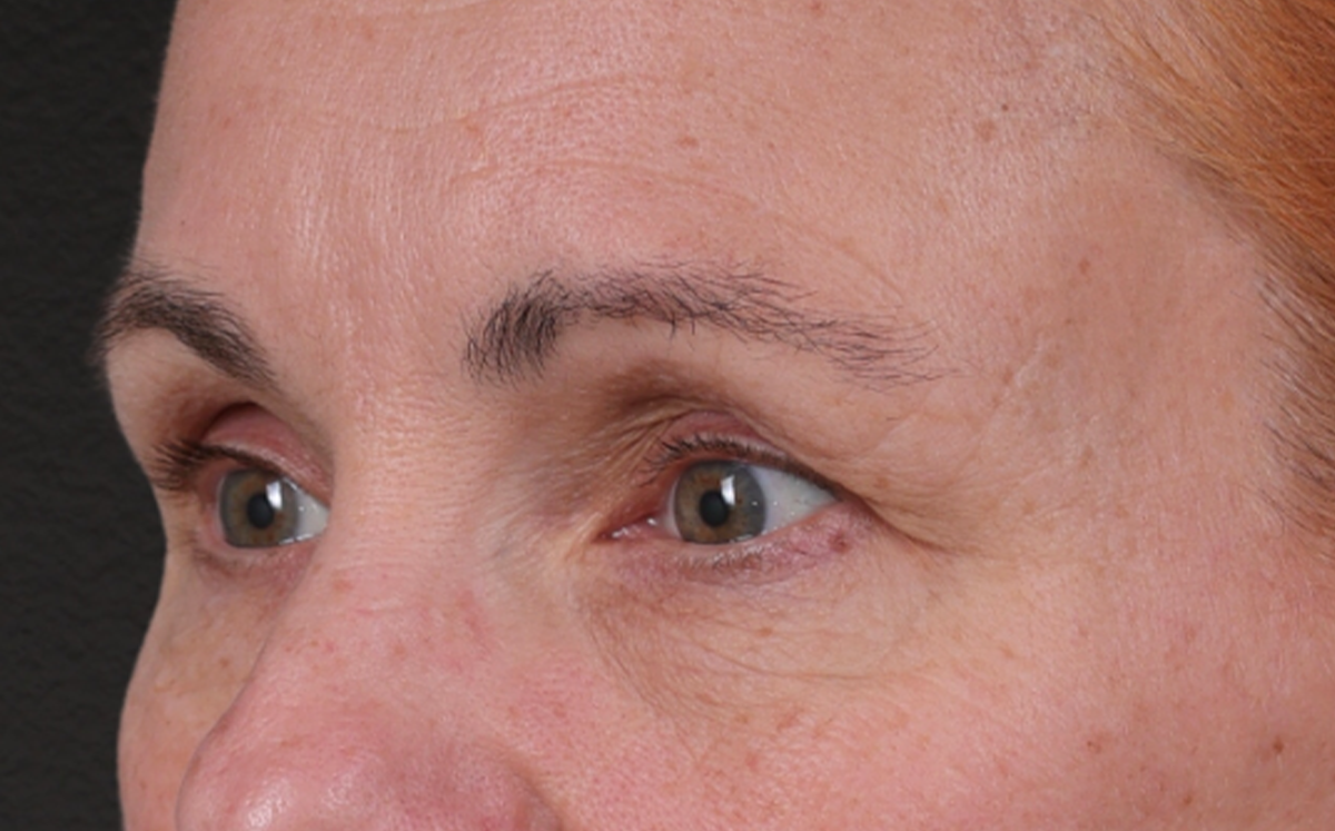 Brow Lift Before & After Gallery - Patient 363898 - Image 7