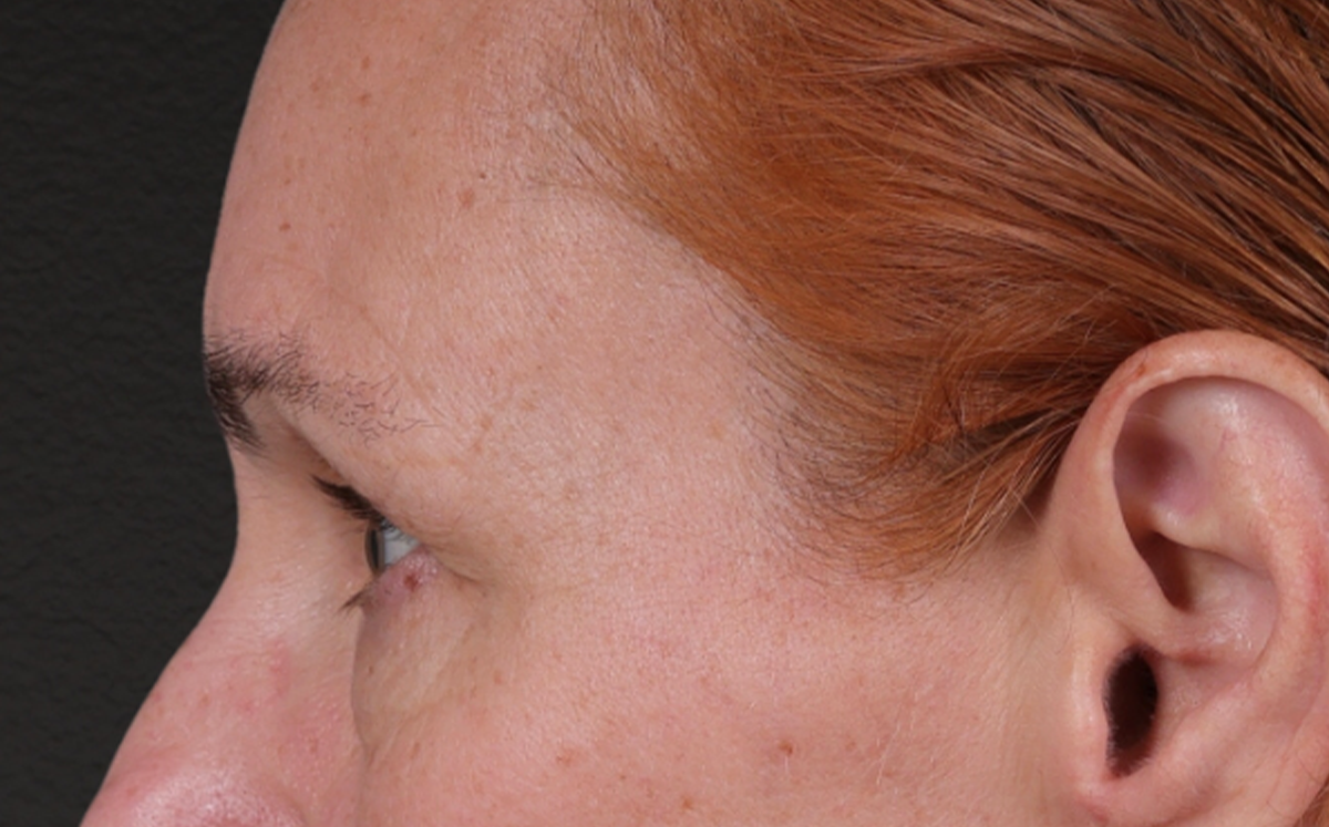 Brow Lift Before & After Gallery - Patient 363898 - Image 9
