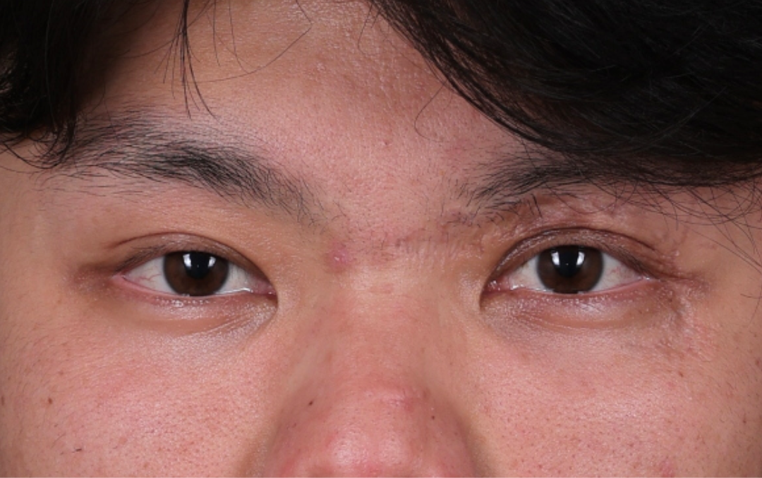 Blepharoplasty Before & After Gallery - Patient 385909 - Image 2