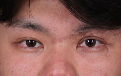 Blepharoplasty Before & After Gallery - Patient 385909 - Image 2