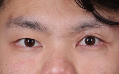 Blepharoplasty Before & After Gallery - Patient 385909 - Image 1