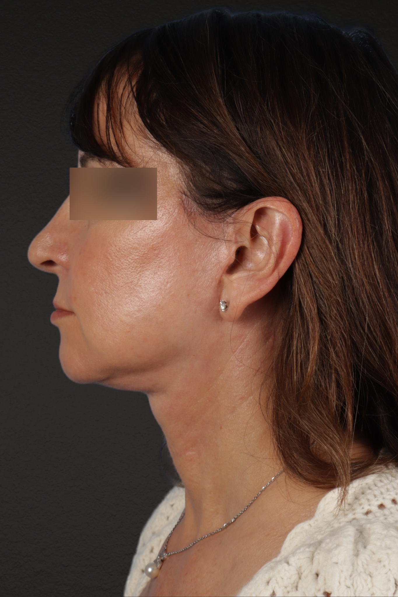 Facelift Before & After Gallery - Patient 407291 - Image 4
