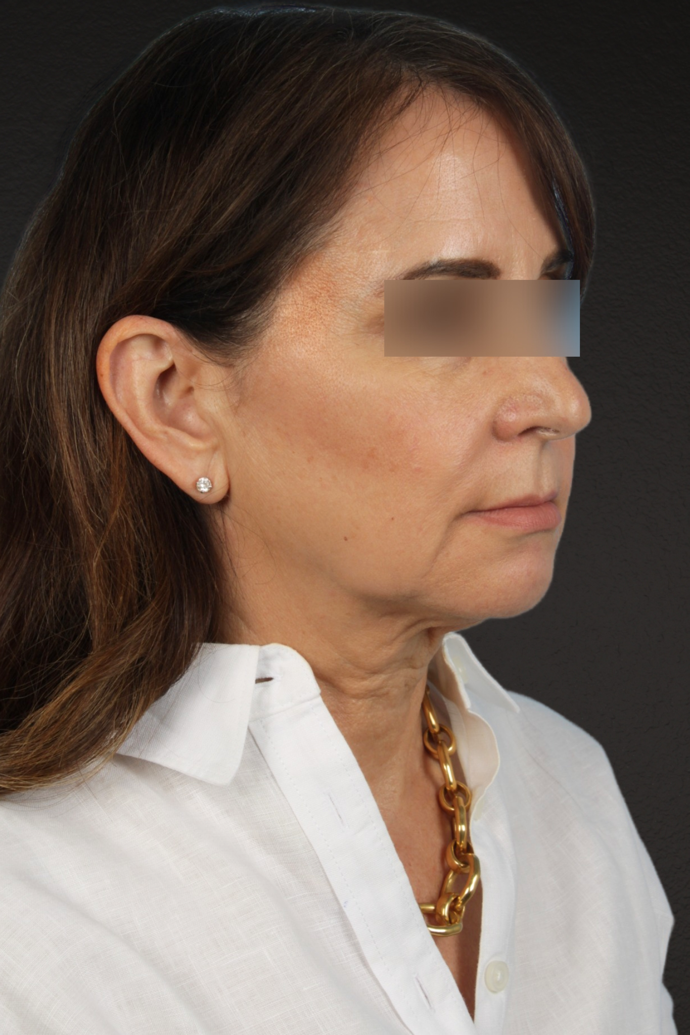 Facelift Before & After Gallery - Patient 407291 - Image 5